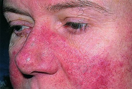 تحليل الذئبة الحمراء-معامل طيبة